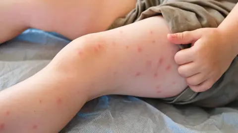 Kızamık Amerika Birleşik Devletleri'ni Tehdit Ediyor.. Sağlık Yetkilisi Aşı Olmanın Gerekliliğini Vurguladı